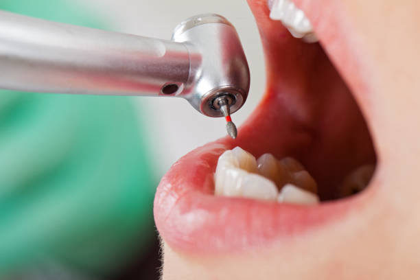 Best Emergency Root Canal Treatment in Brambleton, VA